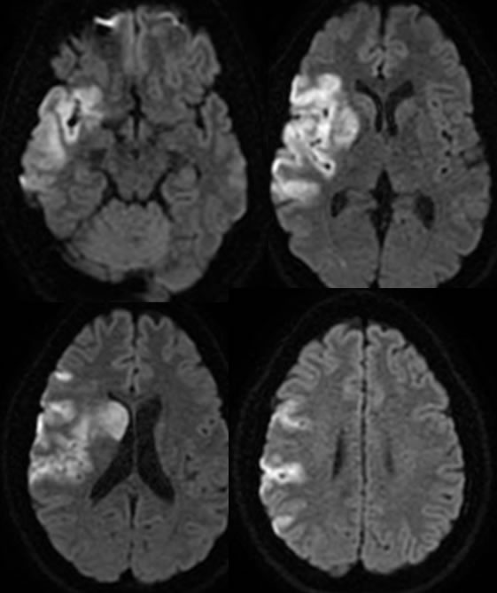 Right M1 Segment Occlusion With Acute Infarct